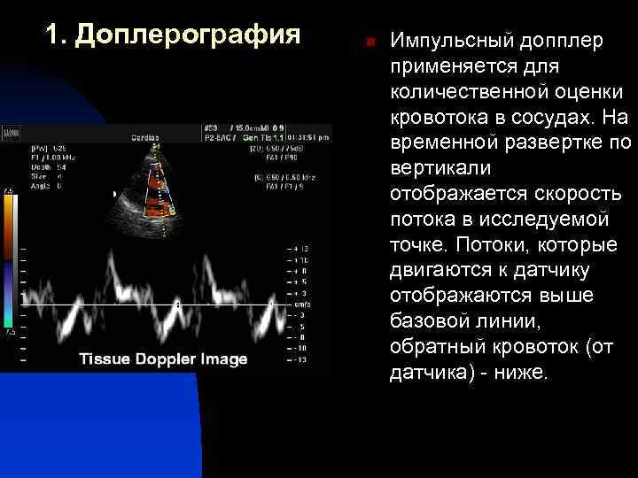 1. Доплерография n Импульсный допплер применяется для количественной оценки кровотока в сосудах. На временной