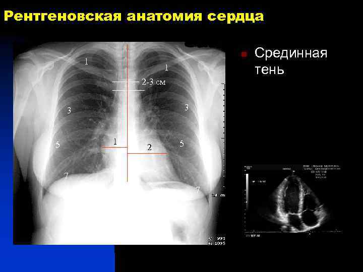 Рентгеновская анатомия сердца n 1 1 2 -3 см 3 3 1 5 2
