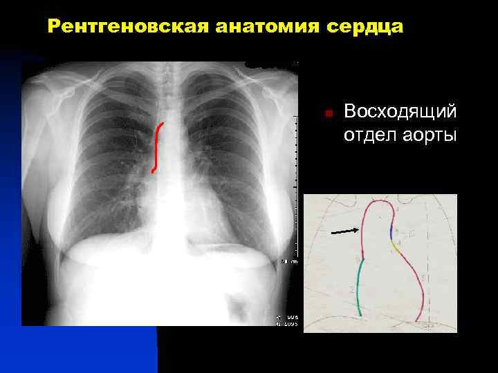 Рентгеновская анатомия сердца n Восходящий отдел аорты 