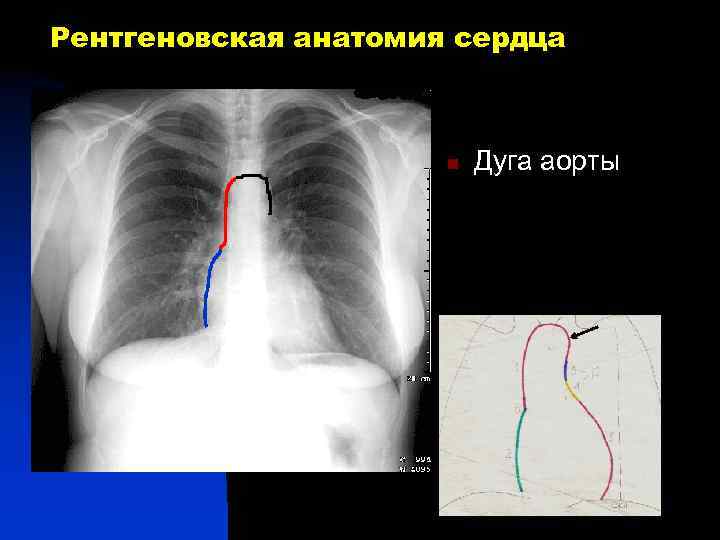 Рентгеновская анатомия сердца n Дуга аорты 