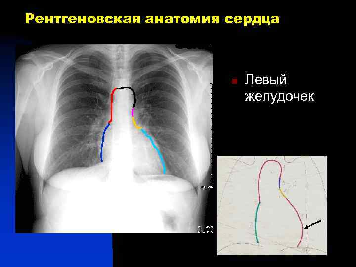 Рентгеновская анатомия сердца n Левый желудочек 