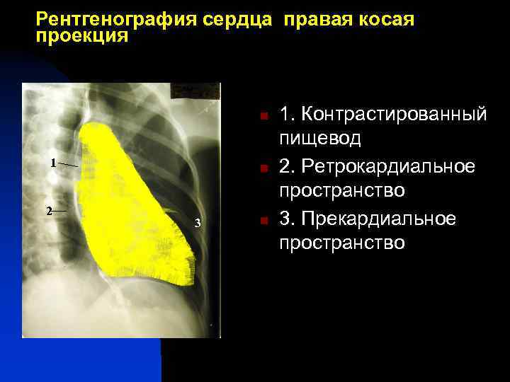 Рентгенография сердца правая косая проекция 1 n 1 2 3 n n 3 5