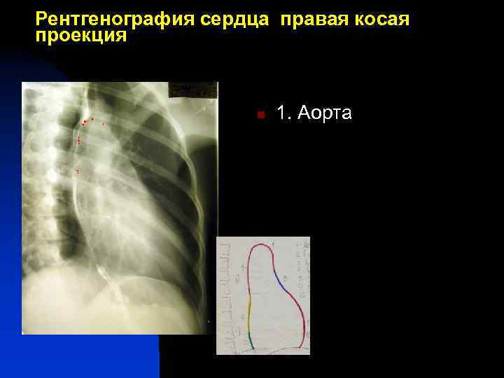Рентгенография сердца правая косая проекция 1 n 3 5 7 1. Аорта 
