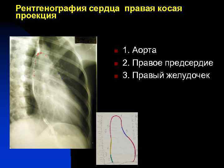 Рентгенография сердца правая косая проекция 1 n n 3 n 5 7 1. Аорта