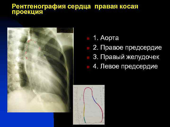 Рентгенография сердца правая косая проекция 1 n n 3 n n 5 7 1.