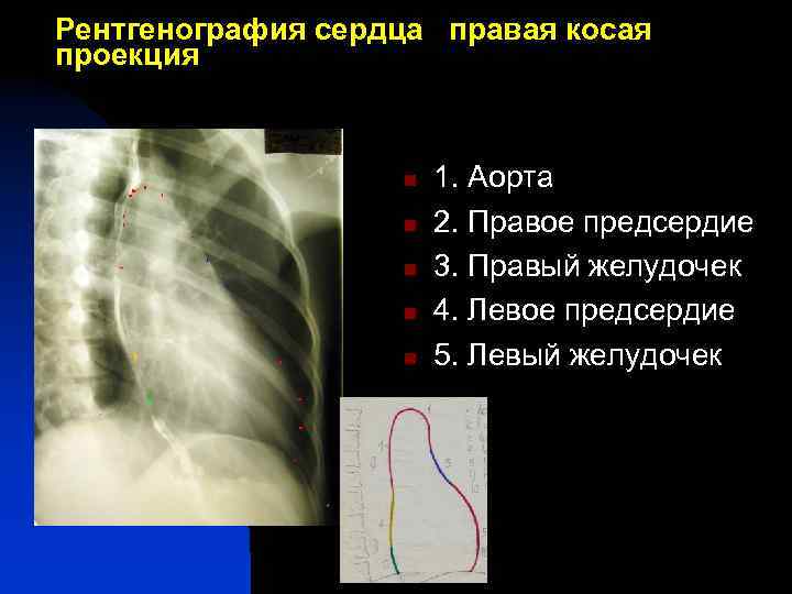 Рентгенография сердца правая косая проекция 1 n n 3 n n 5 7 n