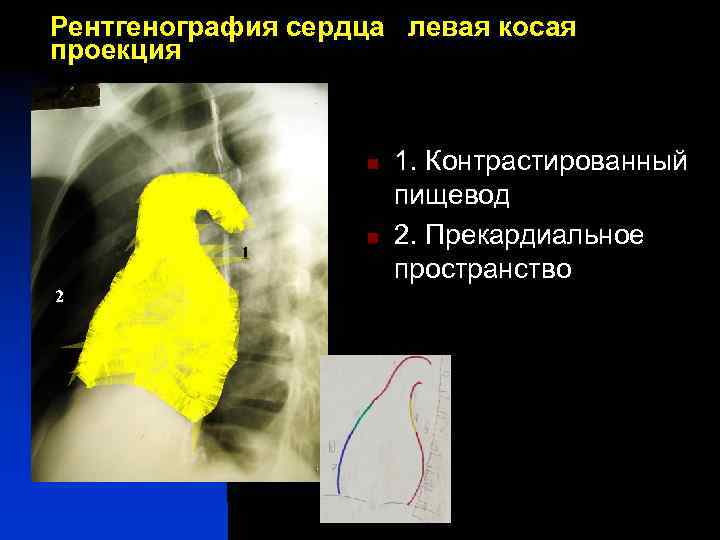 Рентгенография сердца левая косая проекция 11 n 4 n 1 2 5 7 1.