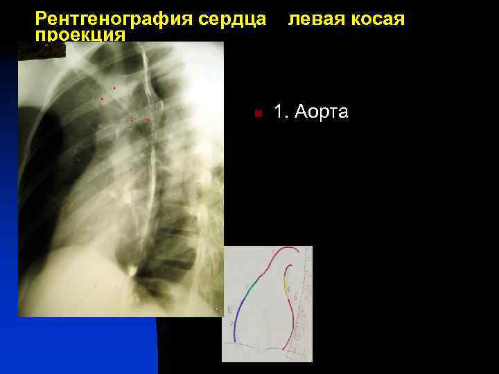 Рентгенография сердца проекция левая косая 1 n 4 1 5 7 1. Аорта 