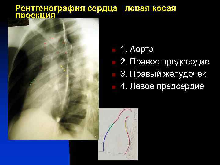 Рентгенография сердца левая косая проекция 1 n n 4 n 1 n 5 7