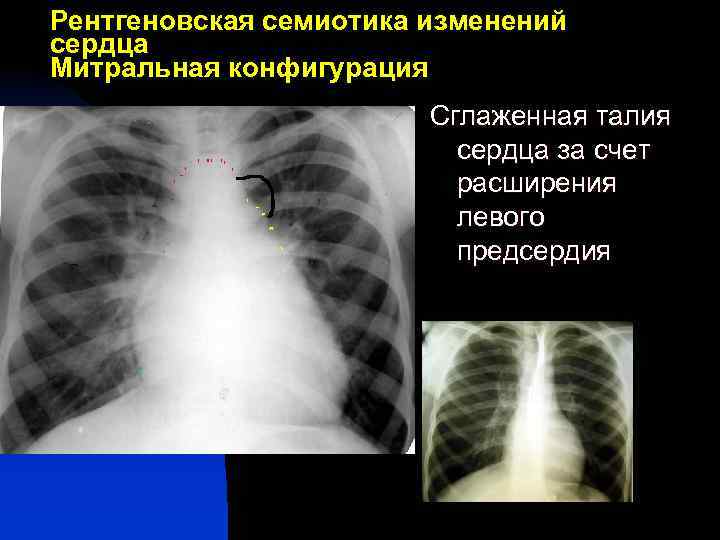Рентгеновская семиотика изменений сердца Митральная конфигурация Сглаженная талия сердца за счет расширения левого предсердия