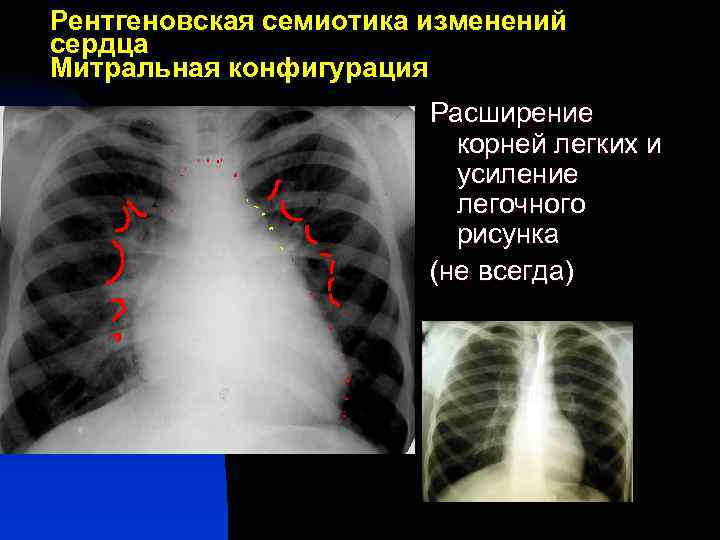 Рентгеновская семиотика изменений сердца Митральная конфигурация Расширение корней легких и усиление легочного рисунка (не