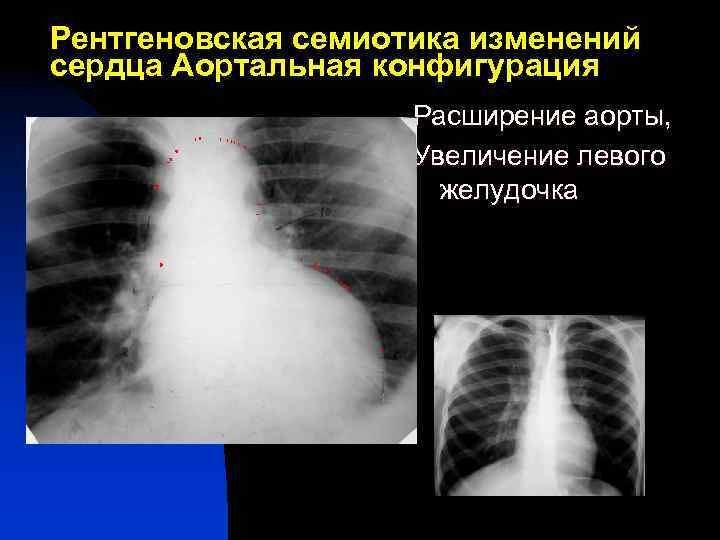 Рентгеновская семиотика изменений сердца Аортальная конфигурация Расширение аорты, Увеличение левого желудочка 