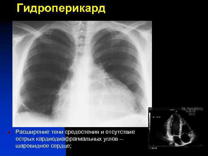 Гидроперикард n Расширение тени средостения и отсутствие острых кардиодиафрагмальных углов – шаровидное сердце; 