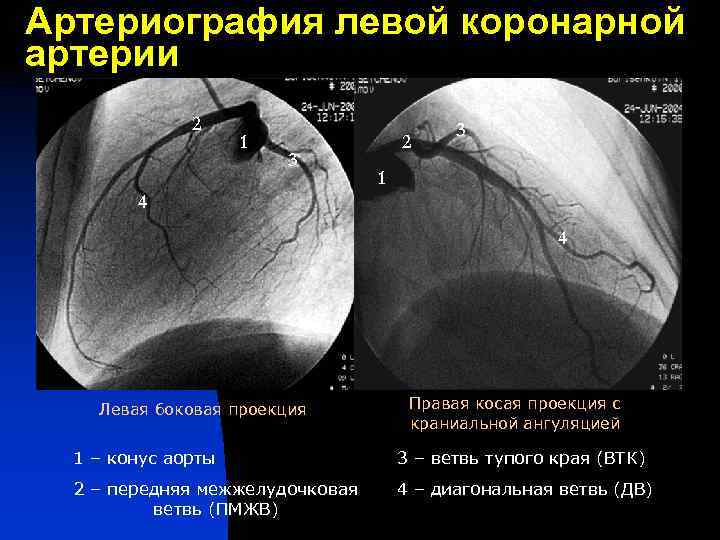 Артериография левой коронарной артерии 2 1 3 2 3 1 4 4 Левая боковая