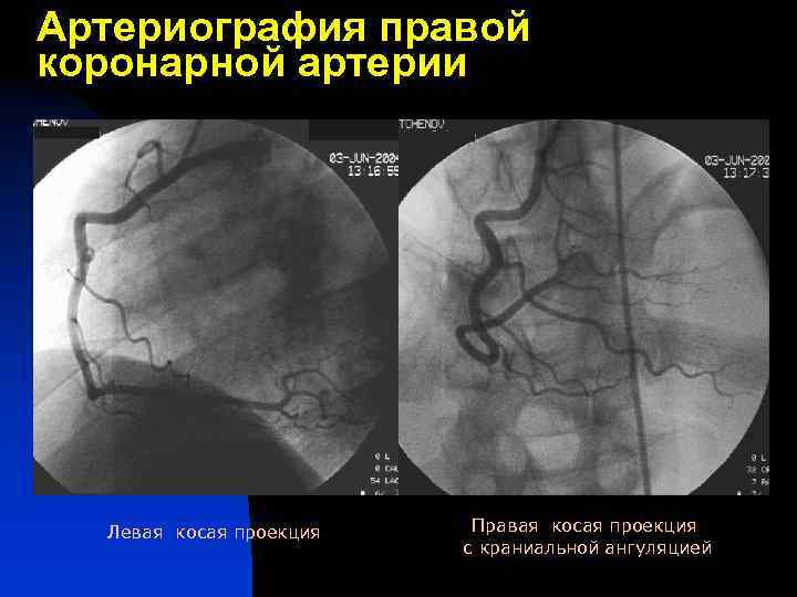 Артериография правой коронарной артерии Левая косая проекция Правая косая проекция с краниальной ангуляцией 