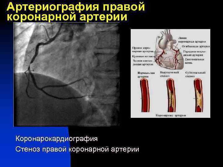 Артериография правой коронарной артерии Коронарокардиография Стеноз правой коронарной артерии 