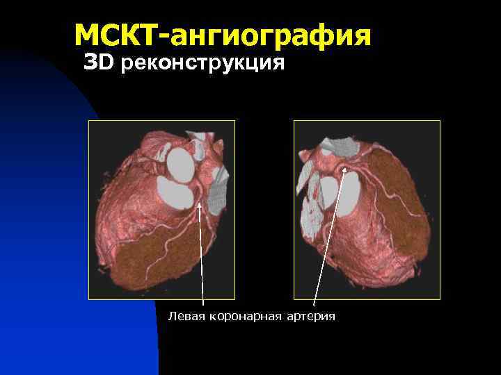 МСКТ-ангиография 3 D реконструкция Левая коронарная артерия 