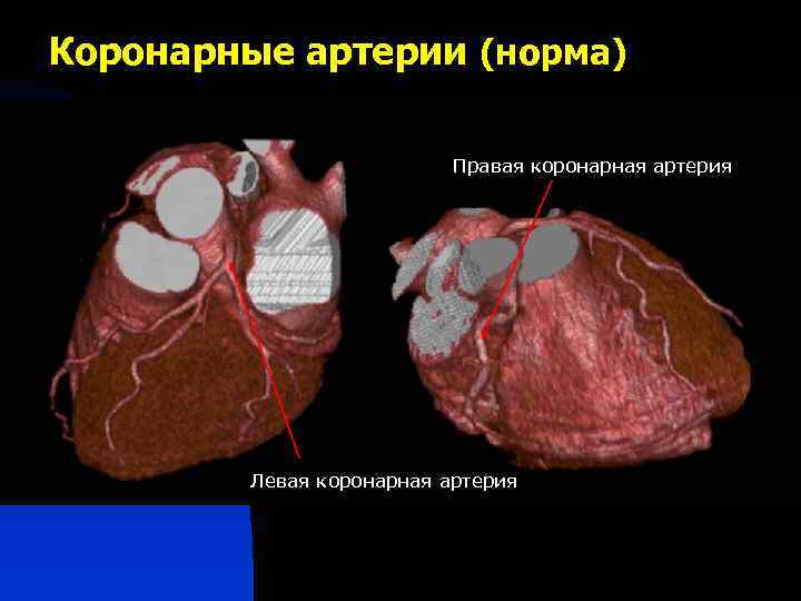 Коронарные артерии (норма) Правая коронарная артерия Левая коронарная артерия 