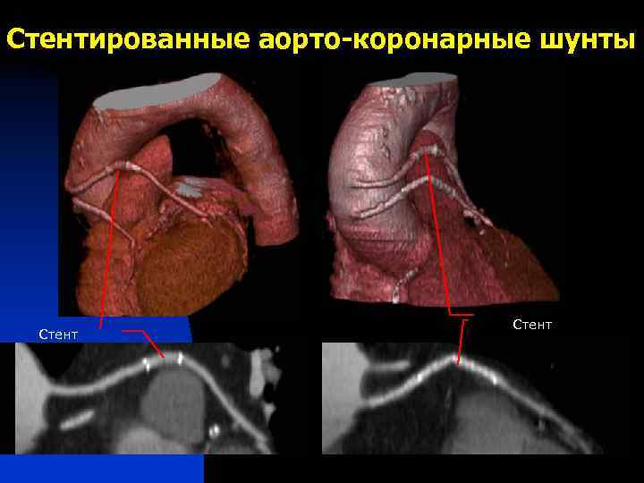 Стентированные аорто-коронарные шунты Стент 