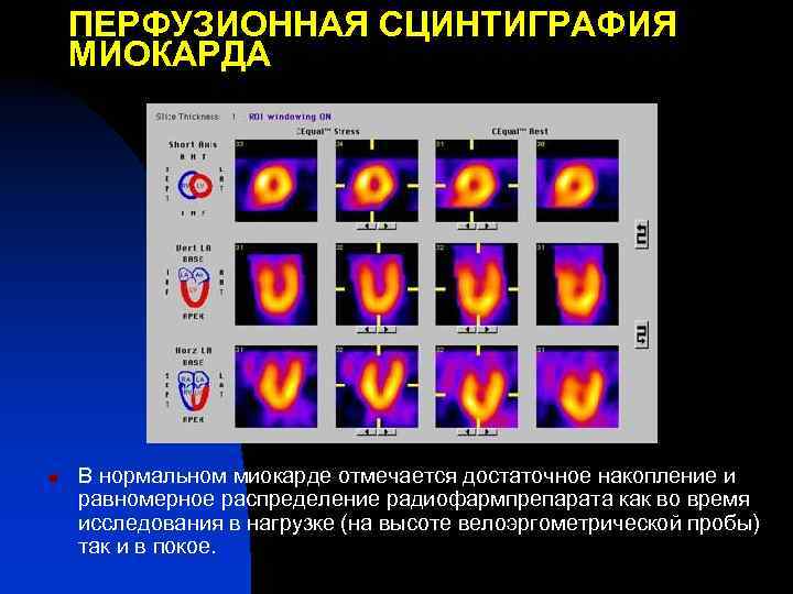 ПЕРФУЗИОННАЯ СЦИНТИГРАФИЯ МИОКАРДА n В нормальном миокарде отмечается достаточное накопление и равномерное распределение радиофармпрепарата