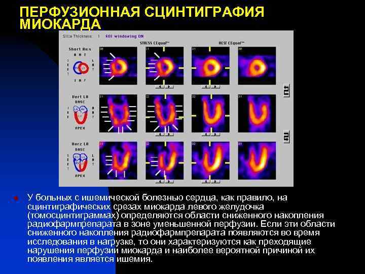 ПЕРФУЗИОННАЯ СЦИНТИГРАФИЯ МИОКАРДА n У больных с ишемической болезнью сердца, как правило, на сцинтиграфических