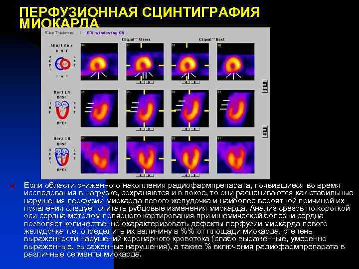 ПЕРФУЗИОННАЯ СЦИНТИГРАФИЯ МИОКАРДА n Если области сниженного накопления радиофармпрепарата, появившиеся во время исследования в