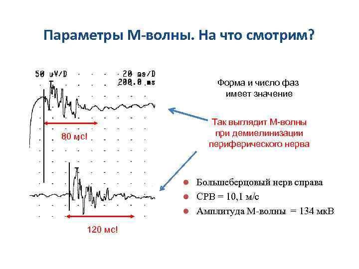 Параметры М-волны. На что смотрим? Форма и число фаз имеет значение Так выглядит М-волны