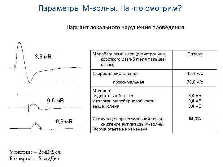 Параметры М-волны. На что смотрим? Вариант локального нарушения проведения Малоберцовый нерв (регистрация с короткого