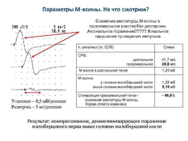 Параметры М-волны. На что смотрим? Снижение амплитуды М-волны в проксимальном участке без дисперсии. Аксональное