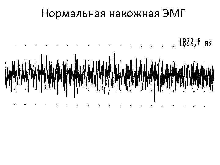 Нормальная накожная ЭМГ Плюсы: Безболезненность Быстрота выполнения Простота Минусы: Малая информативность Субъективизм оценки Ложноположительные