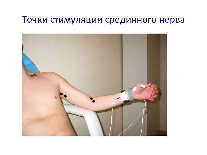 Точки стимуляции срединного нерва 