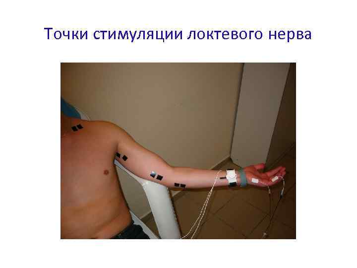 Точки стимуляции локтевого нерва 