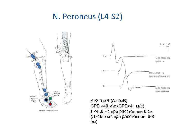 N. Peroneus (L 4 -S 2) А>3. 5 м. В (А>2 м. В) СРВ