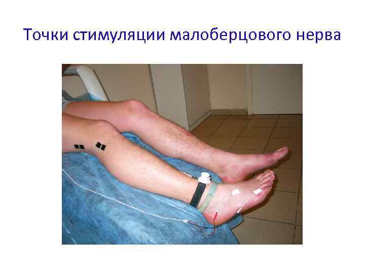 Точки стимуляции малоберцового нерва 