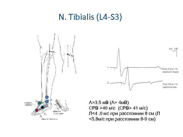 N. Tibialis (L 4 -S 3) А>3. 5 м. В (А> 4 м. В)