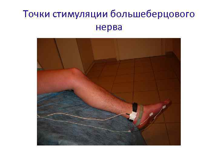 Точки стимуляции большеберцового нерва 