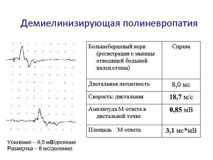 Демиелинизирующая полиневропатия Большеберцовый нерв (регистрация с мышцы отводящей большой палец стопы) Справа Дистальная латентность