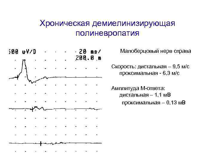 Хроническая демиелинизирующая полиневропатия Малоберцовый нерв справа Скорость: дистальная – 9, 5 м/с проксимальная -