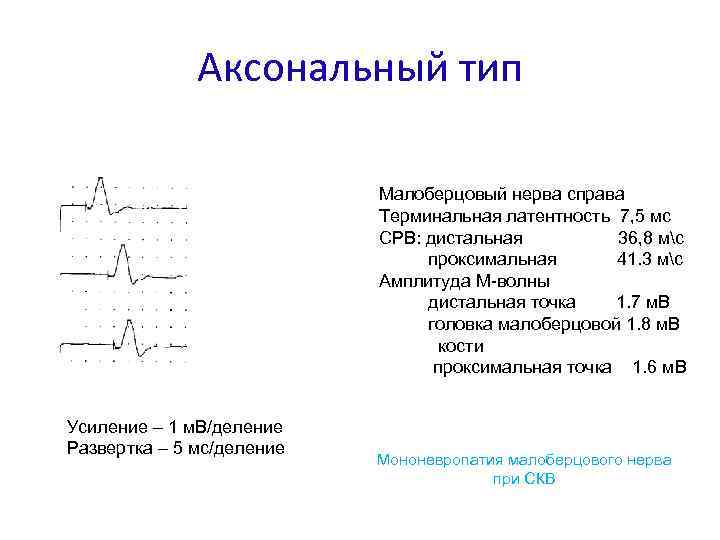 Аксональный тип Малоберцовый нерва справа Терминальная латентность 7, 5 мс СРВ: дистальная 36, 8