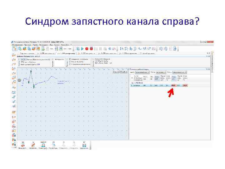 Синдром запястного канала справа? 