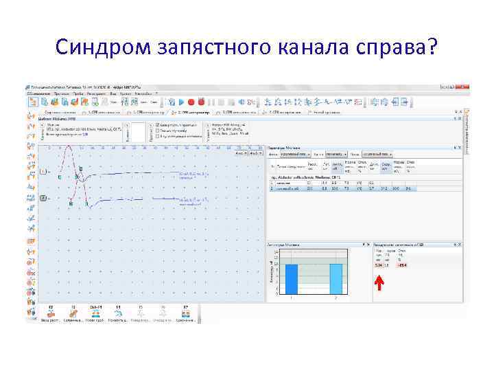 Синдром запястного канала справа? 