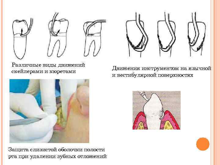 Различные виды движений скейлерами и кюретами Защита слизистой оболочки полости рта при удалении зубных