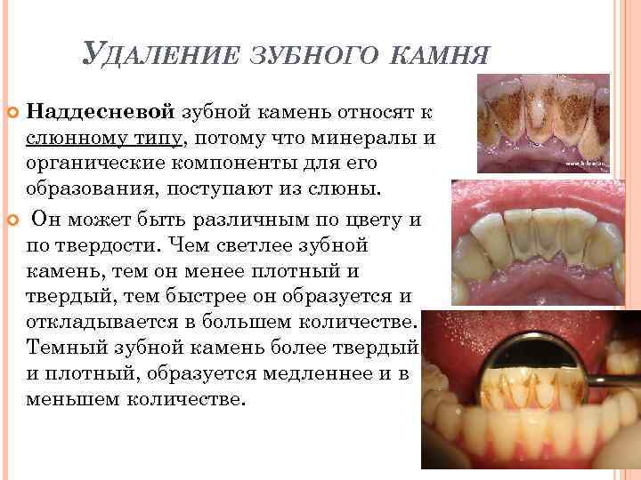 УДАЛЕНИЕ ЗУБНОГО КАМНЯ Наддесневой зубной камень относят к слюнному типу, потому что минералы и