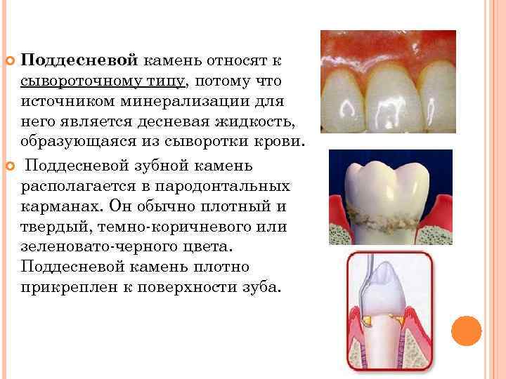 Поддесневой камень относят к сывороточному типу, потому что источником минерализации для него является десневая