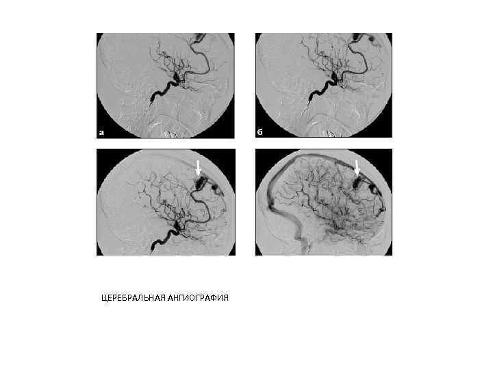ЦЕРЕБРАЛЬНАЯ АНГИОГРАФИЯ 