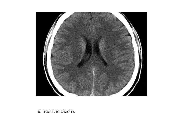 КТ ГОЛОВНОГО МОЗГА 
