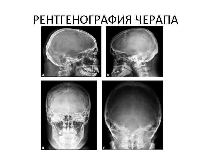 РЕНТГЕНОГРАФИЯ ЧЕРАПА 