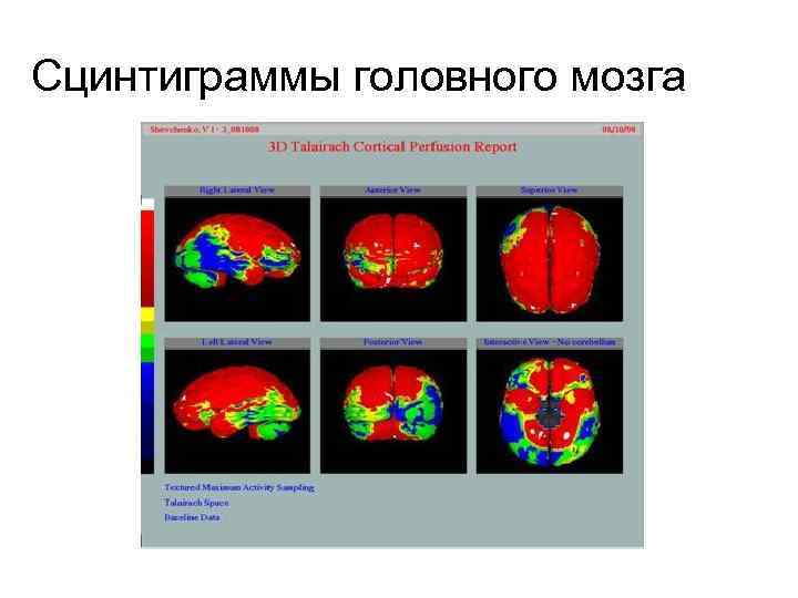 Сцинтиграммы головного мозга 