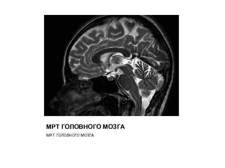МРТ ГОЛОВНОГО МОЗГА 