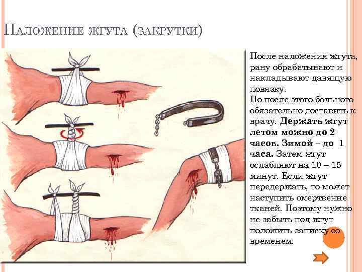 НАЛОЖЕНИЕ ЖГУТА (ЗАКРУТКИ) После наложения жгута, рану обрабатывают и накладывают давящую повязку. Но после